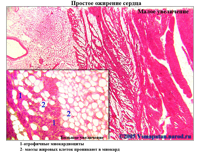 Описание микропрепарата. Ожирение сердца патологическая анатомия макропрепарат. Патологическая анатомия микропрепарат сердца. Жировая дистрофия миокарда микропрепарат. Ожирение миокарда микропрепарат.
