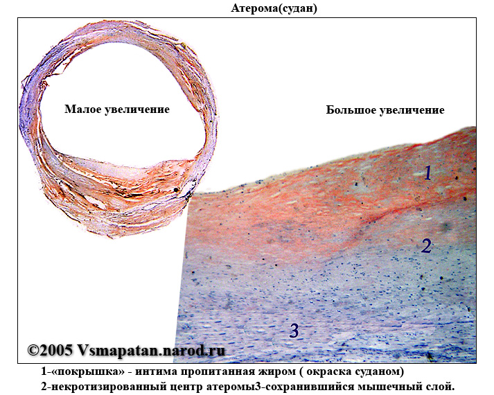 Атерома цитологическая картина