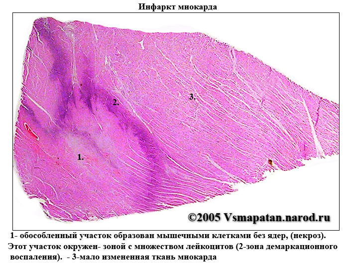 Некроз участка сердечной мышцы