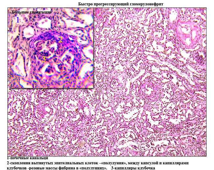 Хронический пиелонефрит микроскопическая картина