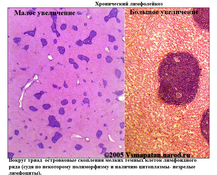 Селезенка при лейкозе. Хронический лимфолейкоз печени микропрепарат. Хронический лимфобластный лейкоз микропрепарат. Хронический лимфолейкоз селезенка гистология. Хронический лимфолейкоз микропрепарат селезенки.